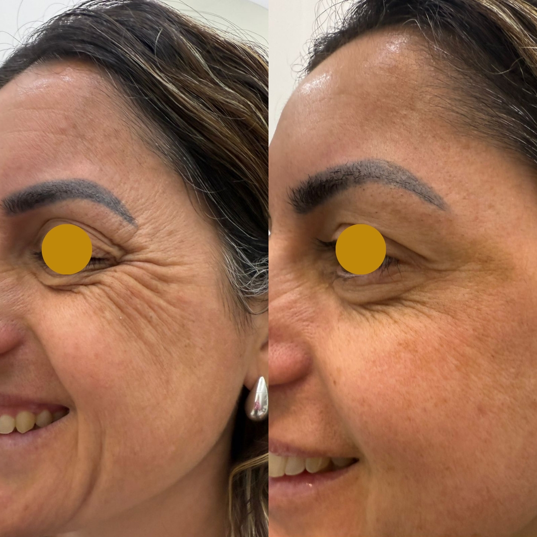 Antes e depois de Botox nos pés de galinha