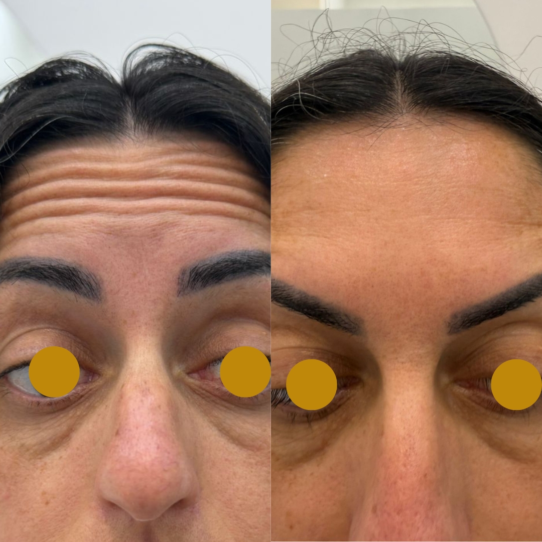 Antes e depois de Botox na testa