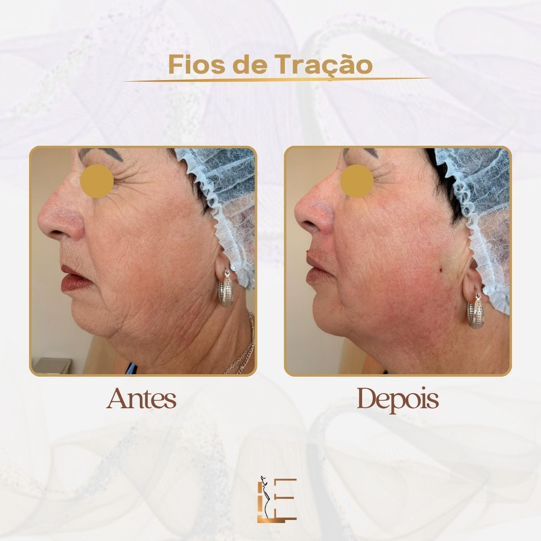 Resultado de lifting facial com fios de tração