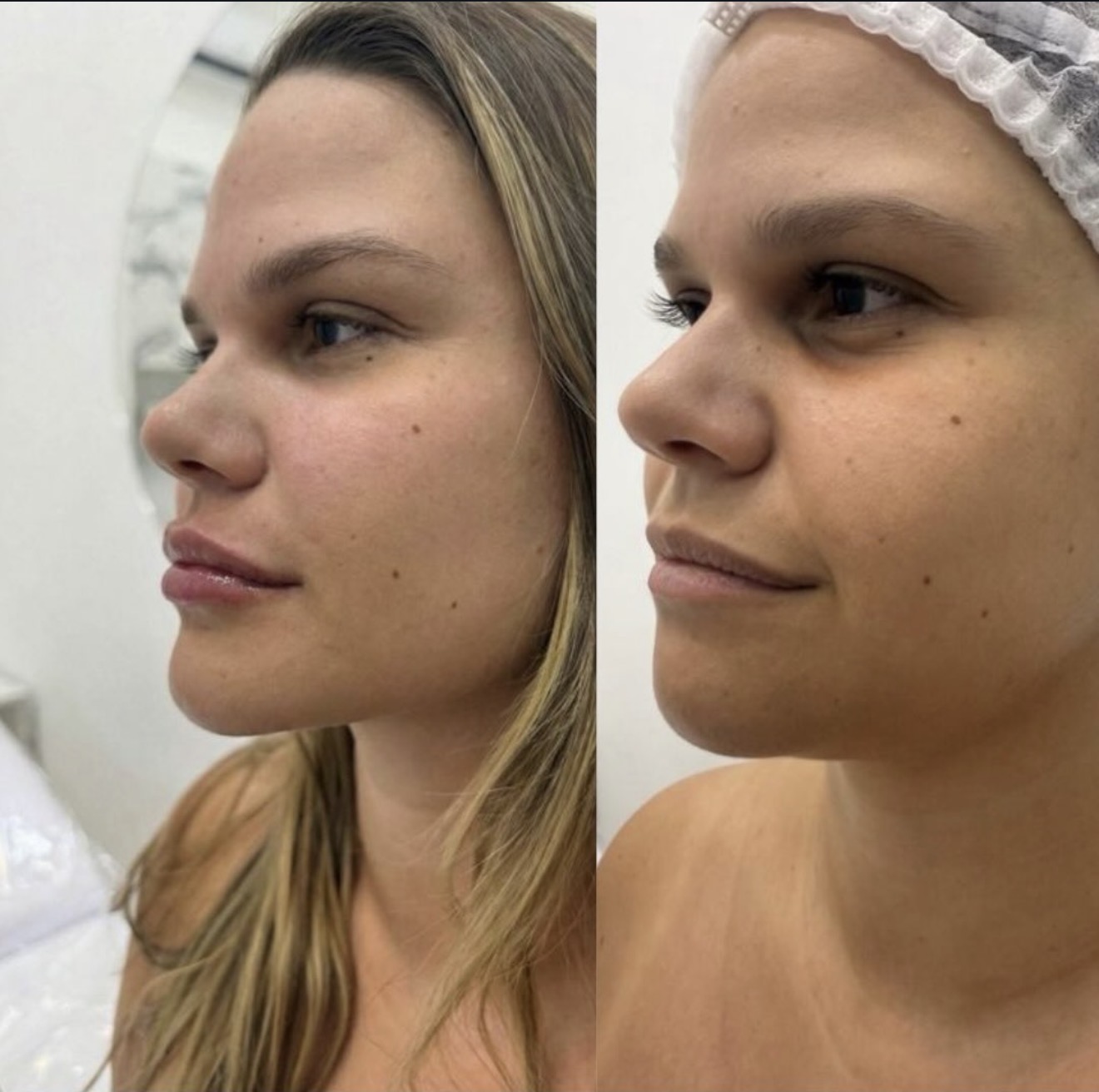 Antes e depois de protocolo Full Face