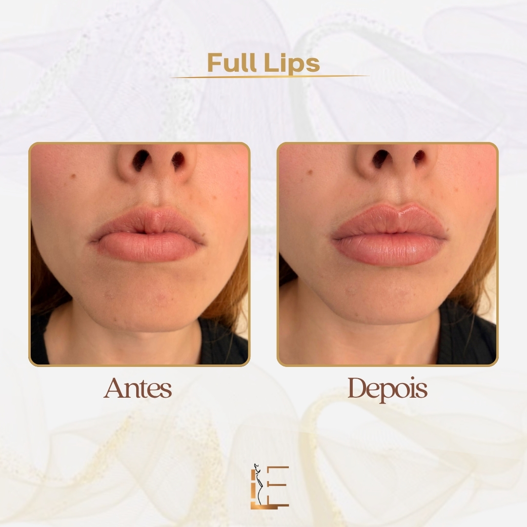 Antes e depois do protocolo Full Lips