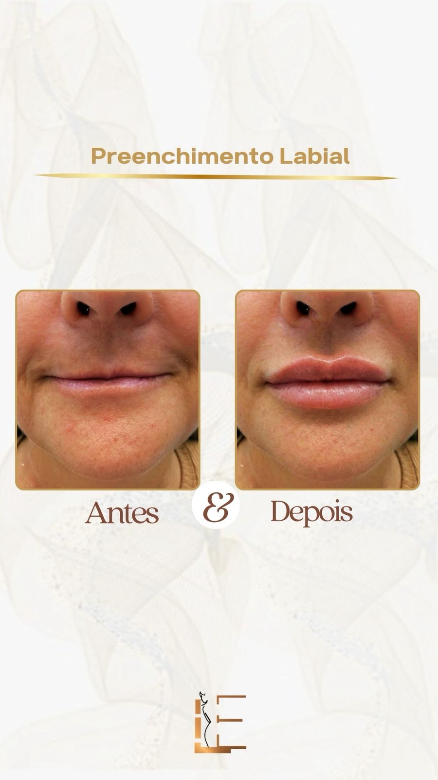 Antes e depois de preenchimento labial